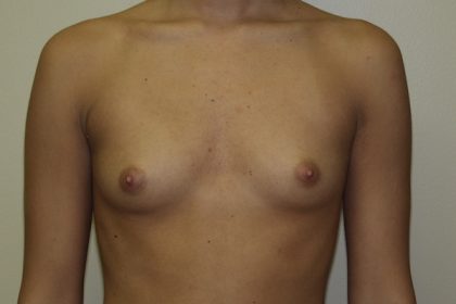 Breast Augmentation Before & After Patient #2710