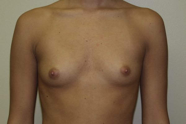 Breast Augmentation Before & After Patient #2710