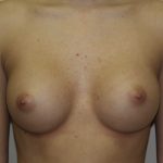 Breast Augmentation Before & After Patient #2710