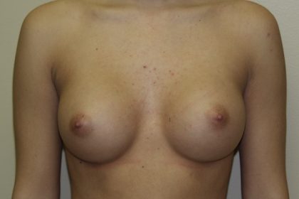 Breast Augmentation Before & After Patient #2710