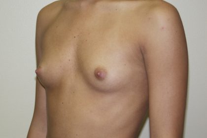 Breast Augmentation Before & After Patient #2710