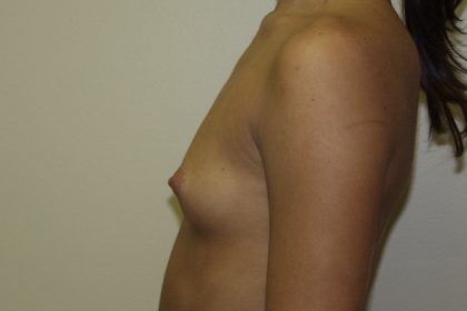 Breast Augmentation Before & After Patient #2710