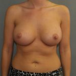 Breast Augmentation Before & After Patient #2738