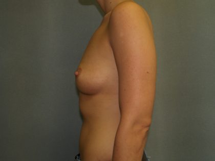 Breast Augmentation Before & After Patient #2738