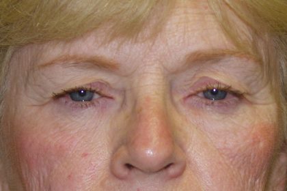 Eye Lid Lift Before & After Patient #702