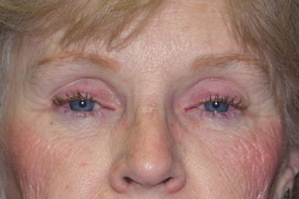 Eye Lid Lift Before & After Patient #702