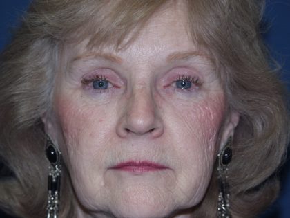 Brow Lift Before & After Patient #526