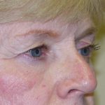 Eye Lid Lift Before & After Patient #702