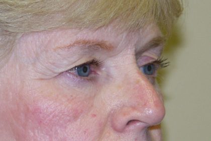 Eye Lid Lift Before & After Patient #702