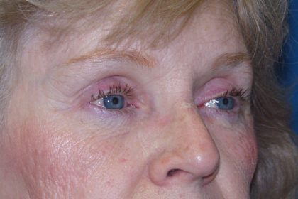 Eye Lid Lift Before & After Patient #702