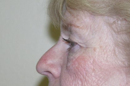 Eye Lid Lift Before & After Patient #702
