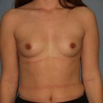 Breast Augmentation Before & After Patient #2773