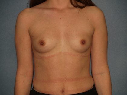 Breast Augmentation Before & After Patient #2773