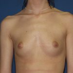 Breast Augmentation Before & After Patient #2962