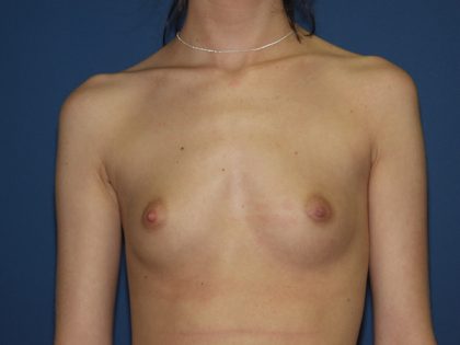 Breast Augmentation Before & After Patient #2962