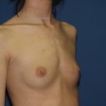 Breast Augmentation Before & After Patient #2962