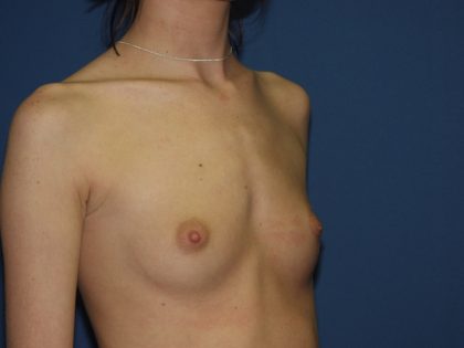 Breast Augmentation Before & After Patient #2962