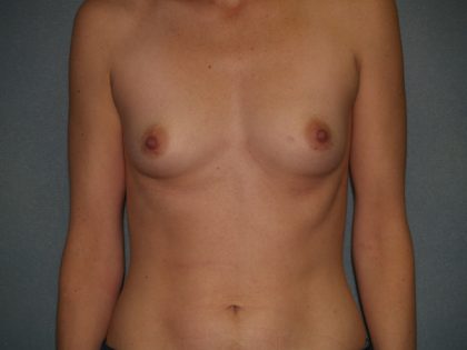 Breast Augmentation Before & After Patient #3060