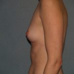 Breast Augmentation Before & After Patient #3060