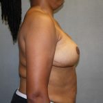 Breast Reconstruction Before & After Patient #1732