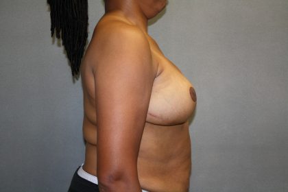 Breast Reconstruction Before & After Patient #1732