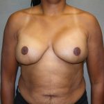 Breast Reconstruction Before & After Patient #1732