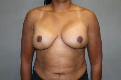 Breast Reconstruction Before & After Patient #1732