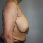 Breast Reconstruction Before & After Patient #1732