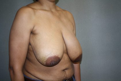 Breast Reconstruction Before & After Patient #1732