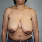 Breast Reconstruction Before & After Patient #1732