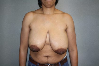 Breast Reconstruction Before & After Patient #1732