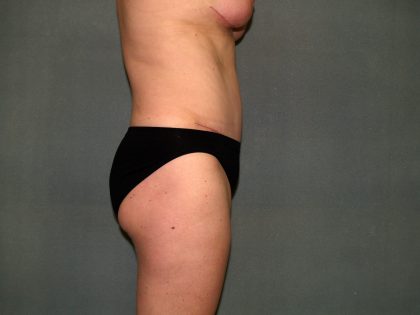 Tummy Tuck Before & After Patient #2208
