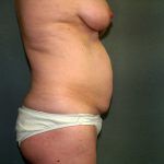 Tummy Tuck Before & After Patient #2208