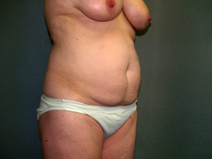 Tummy Tuck Before & After Patient #2208