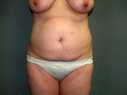 Tummy Tuck Before & After Patient #2208