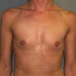 Breast Augmentation Before & After Patient #3025