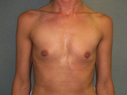 Breast Augmentation Before & After Patient #3025