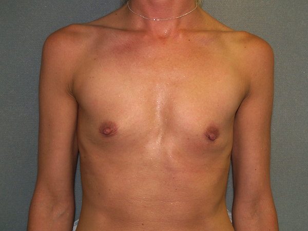 Breast Augmentation Before & After Patient #3025