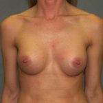 Breast Augmentation Before & After Patient #3025