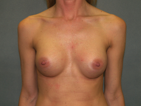 Breast Augmentation Before & After Patient #3025