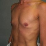 Breast Augmentation Before & After Patient #3025