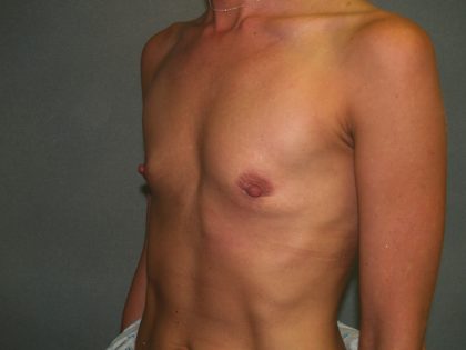 Breast Augmentation Before & After Patient #3025