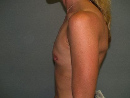 Breast Augmentation Before & After Patient #3025
