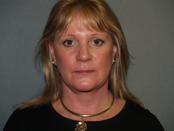 Facelift Before & After Patient #578
