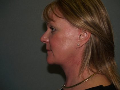 Facelift Before & After Patient #578
