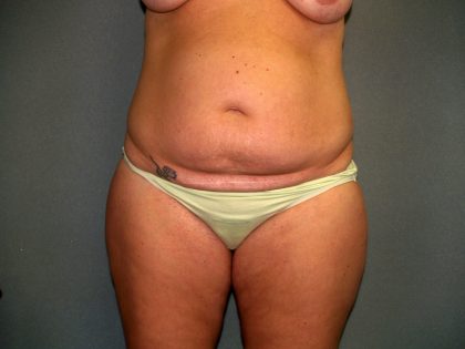 Tummy Tuck Before & After Patient #2417