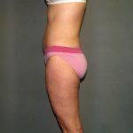 Tummy Tuck Before & After Patient #2417