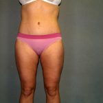 Tummy Tuck Before & After Patient #2417