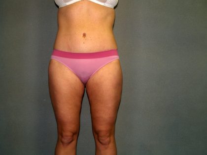 Tummy Tuck Before & After Patient #2417