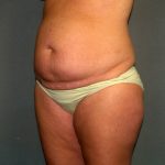 Tummy Tuck Before & After Patient #2417